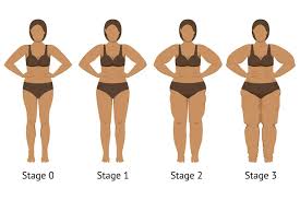 An Expert Opinion on Lipoedema with Linda Anne Kahn